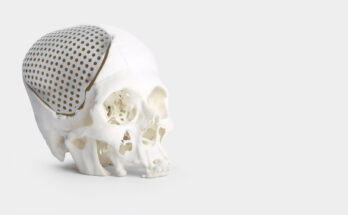 3D Printed Medical Implants Market