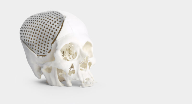 3D Printed Medical Implants Market