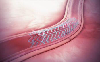 Bioabsorbable Stents