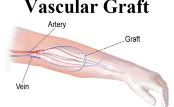 Vascular Grafts Market