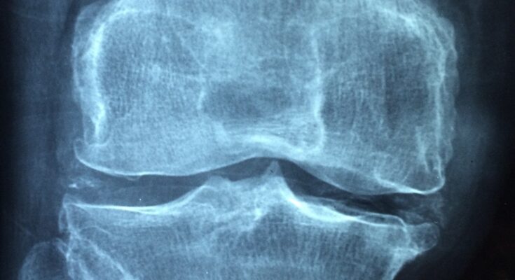 arthritis monoclonal antibodies market