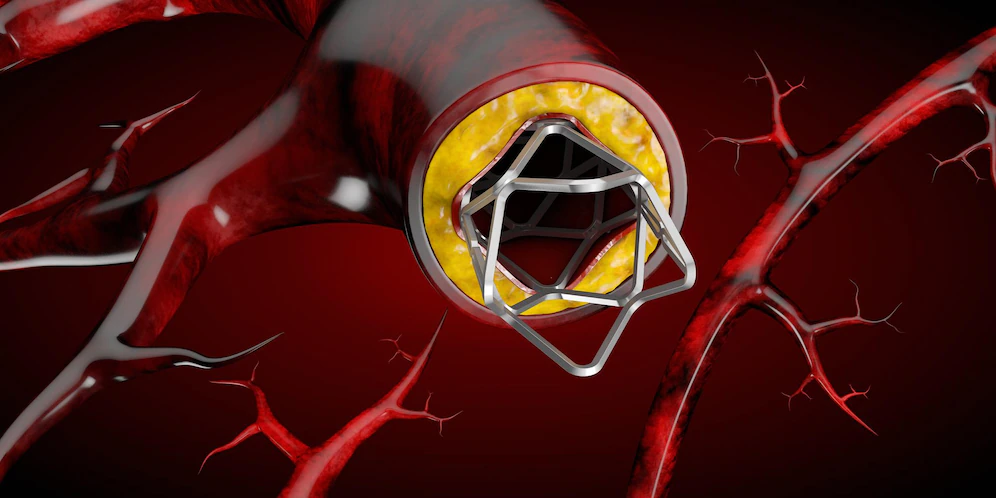 Bioabsorbable Stents Market