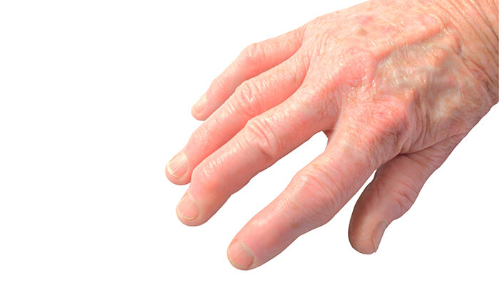 global psoriatic arthritis treatment market