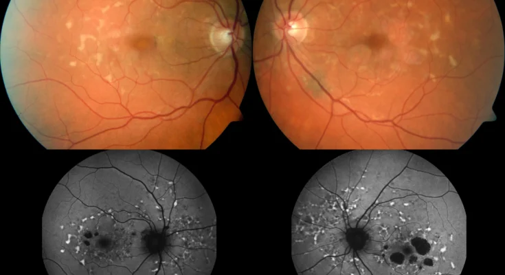 Stargardt Disease Therapeutics Market