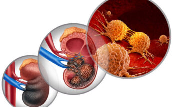 kidney cancer drugs market