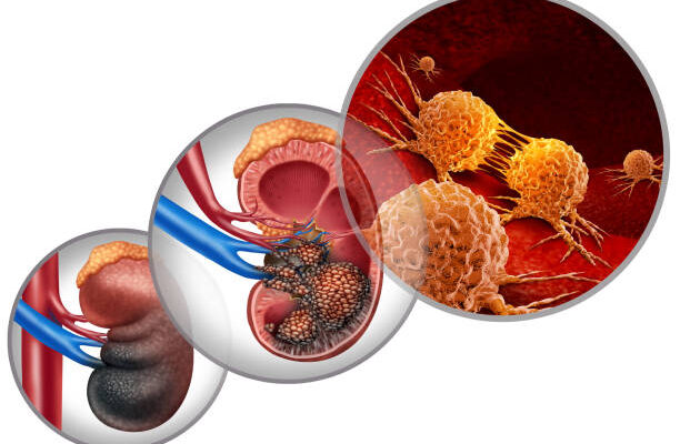 kidney cancer drugs market