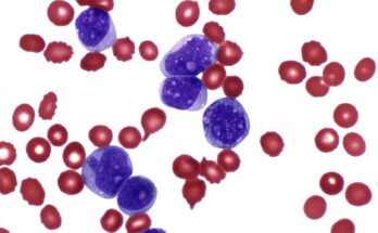 Acute Myeloid Leukemia Global Market