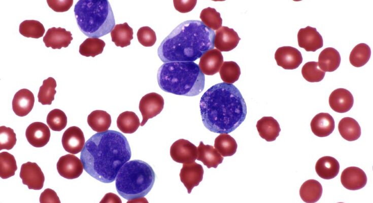 Acute Myeloid Leukemia Global Market