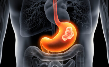 gastric cancer drugs market