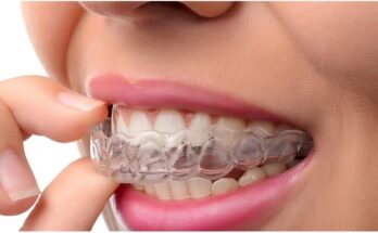 Clear Aligners Market 2022 - Opportunities And Strategies – Global Forecast To 2031