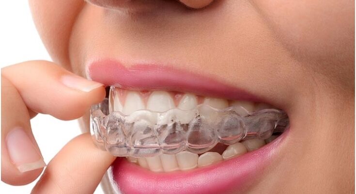 Clear Aligners Market 2022 - Opportunities And Strategies – Global Forecast To 2031