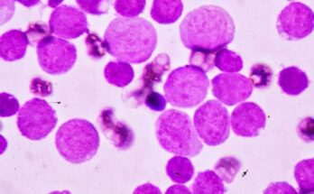 acute myeloid leukemia market segmentation