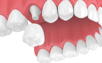 pediatric dental crown market