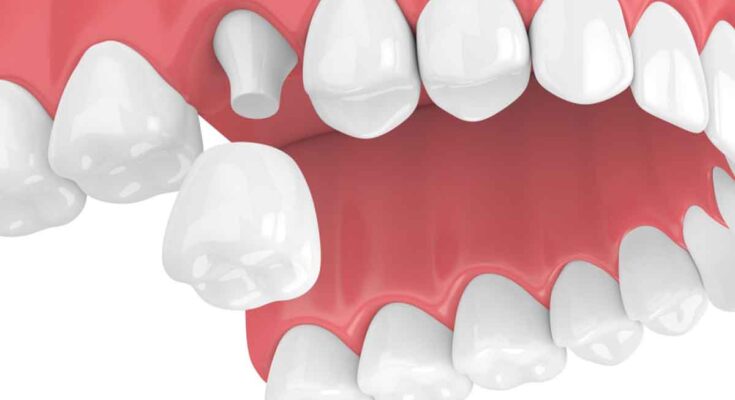 pediatric dental crown market