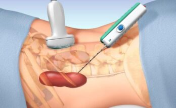 Global Core Needle Biopsy Devices Market