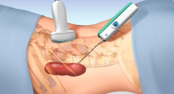 Global Core Needle Biopsy Devices Market