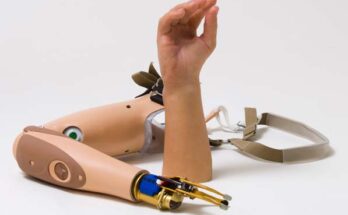 Global Myo-Electric Hand Prosthesis Market