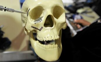 craniomaxillofacial (cmf) devices and equipment market