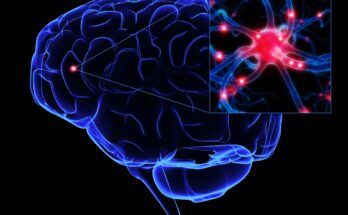 Global Brain Stroke Market