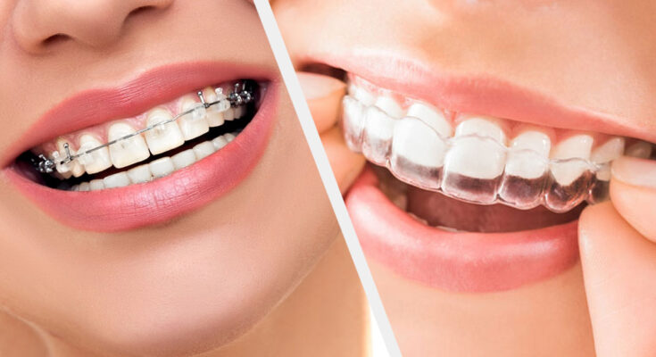 Clear Aligners Market