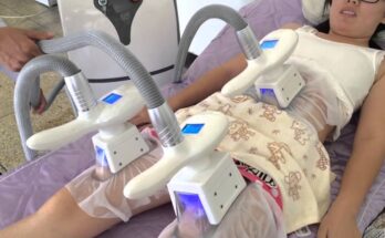 Cryolipolysis Machine Market