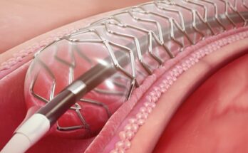 Drug Eluting Stent Market