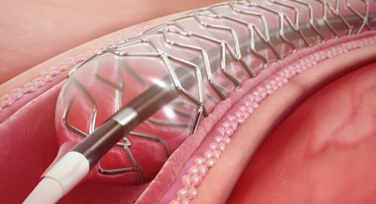 Drug Eluting Stent Market