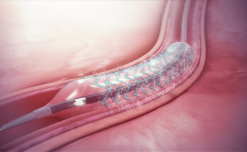 Drug Eluting Stents (DES)