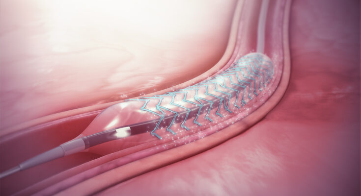 Drug Eluting Stents (DES)