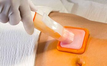 Global Preoperative Skin Preparation Market