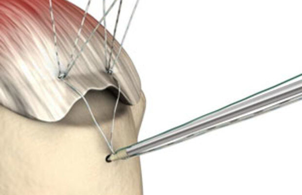 Global Suture Anchor Market