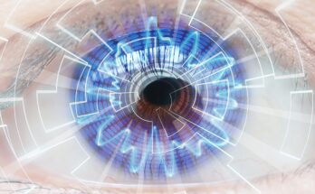 Global Wavefront Lasik Market