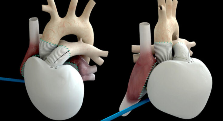 Artificial Heart