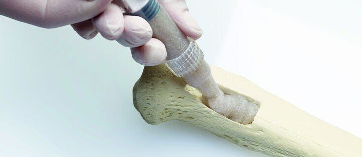 Bone Grafts and Substitutes