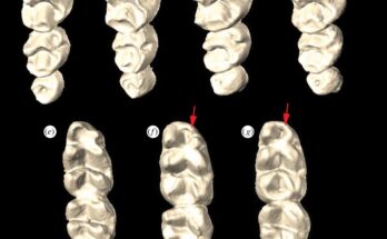 Bone Morphogenetic Protein