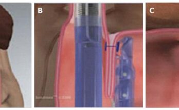 Esophageal Electrophysiology Device