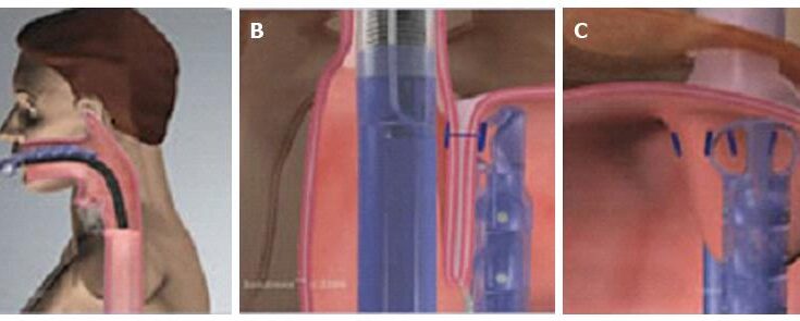 Esophageal Electrophysiology Device