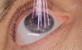 LASIK Laser System