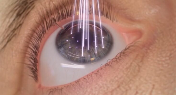 LASIK Laser System