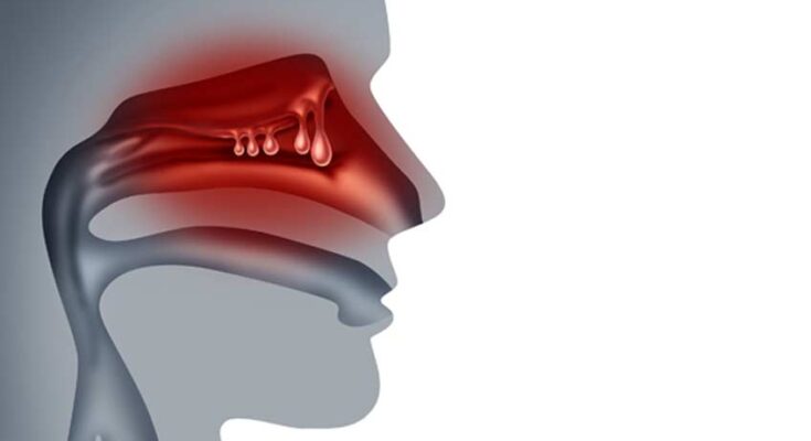 Nasal Polyps Treatment Global Market