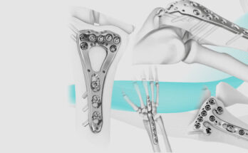 Orthopedic Digit Implants