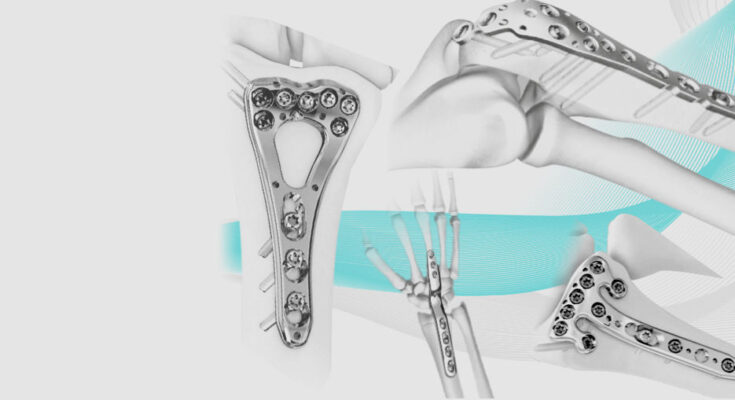 Orthopedic Digit Implants