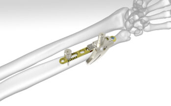 Osteotomy System