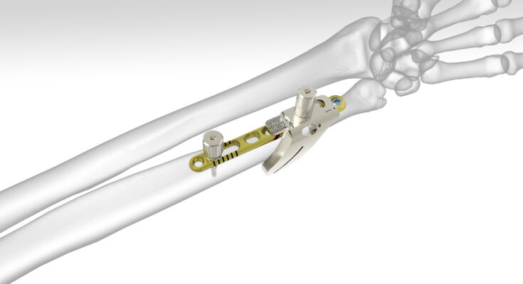 Osteotomy System