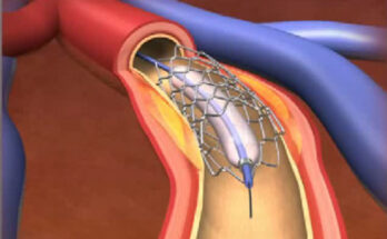 Percutaneous Coronary Intervention Market