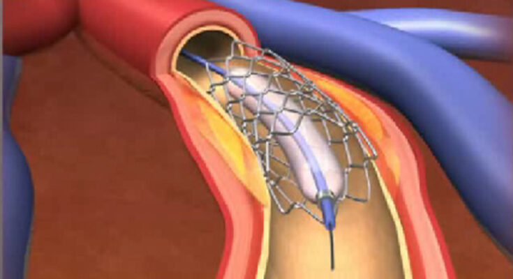 Percutaneous Coronary Intervention Market