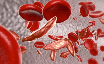 Sickle Cell Anemia Therapeutics