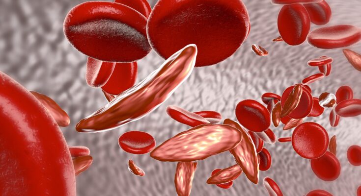 Sickle Cell Anemia Therapeutics