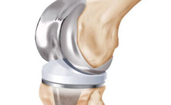 Small Joint Replacement