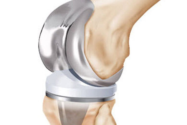 Small Joint Replacement